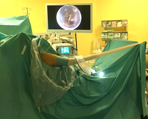 Chirurgie arthroscopique de l'épaule - Orthosud Montpellier