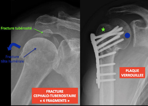 Traitement des fractures - Orthosud Montpellier