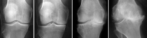Arthrose du genou : gonarthrose | Orthosud Montpellier