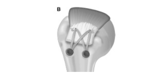 anatomie de l'epaule
