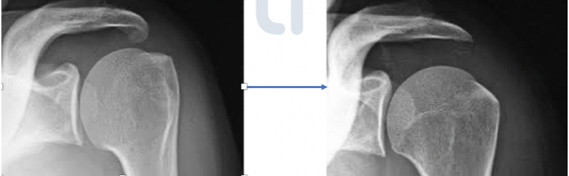 anatomie de l'epaule