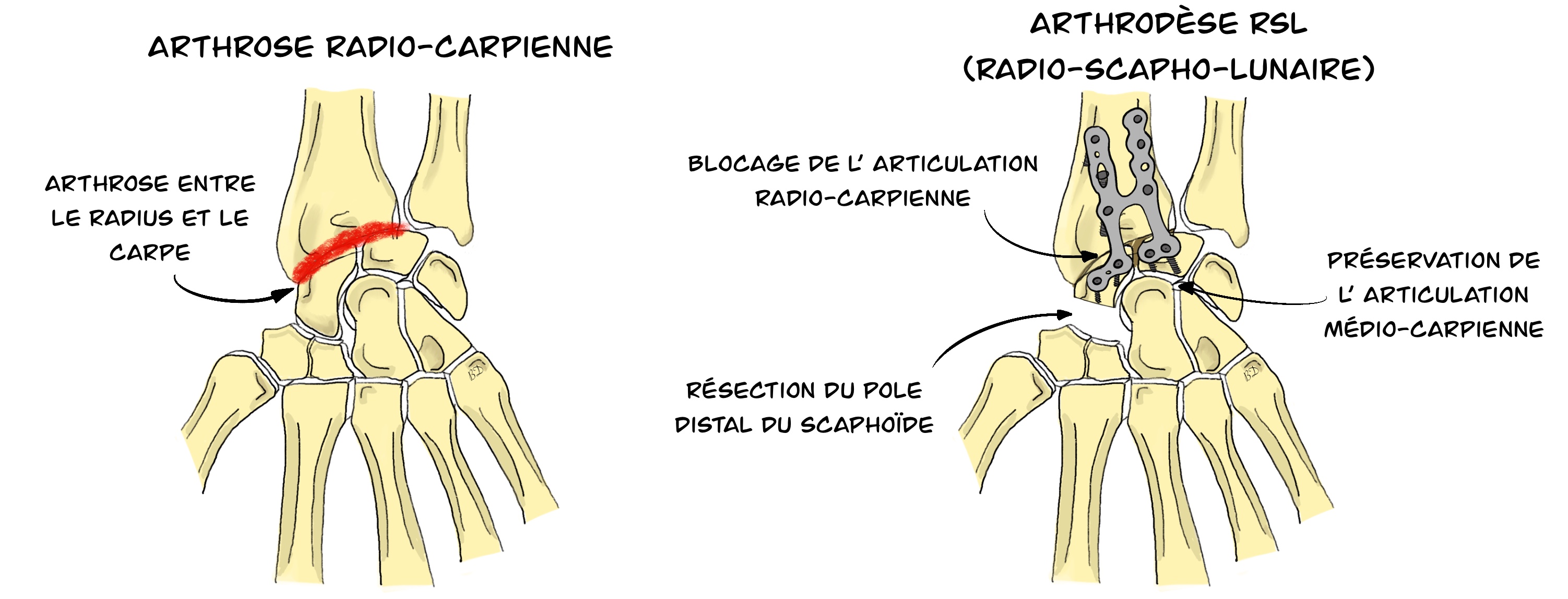 Arthrodèse Radio-Scapho-Lunaire (RSL)