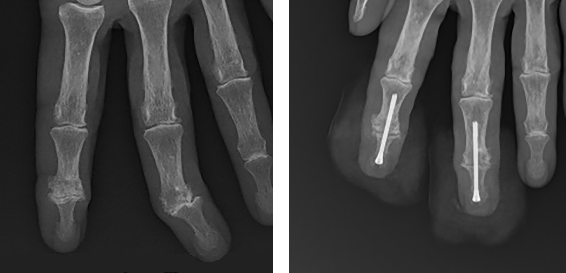 Arthrodèse de doigt