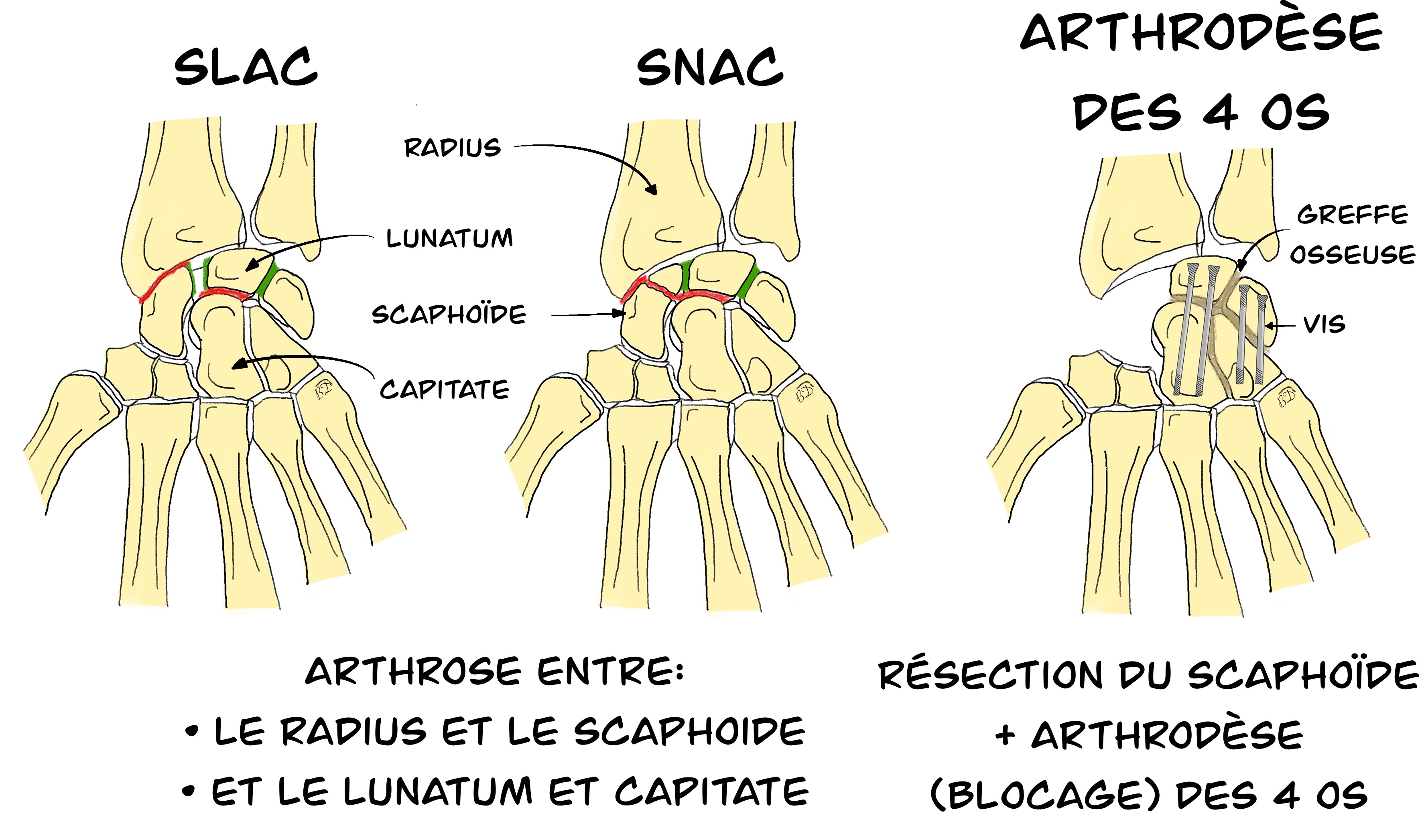 Arthrodèse des 4 os du carpe