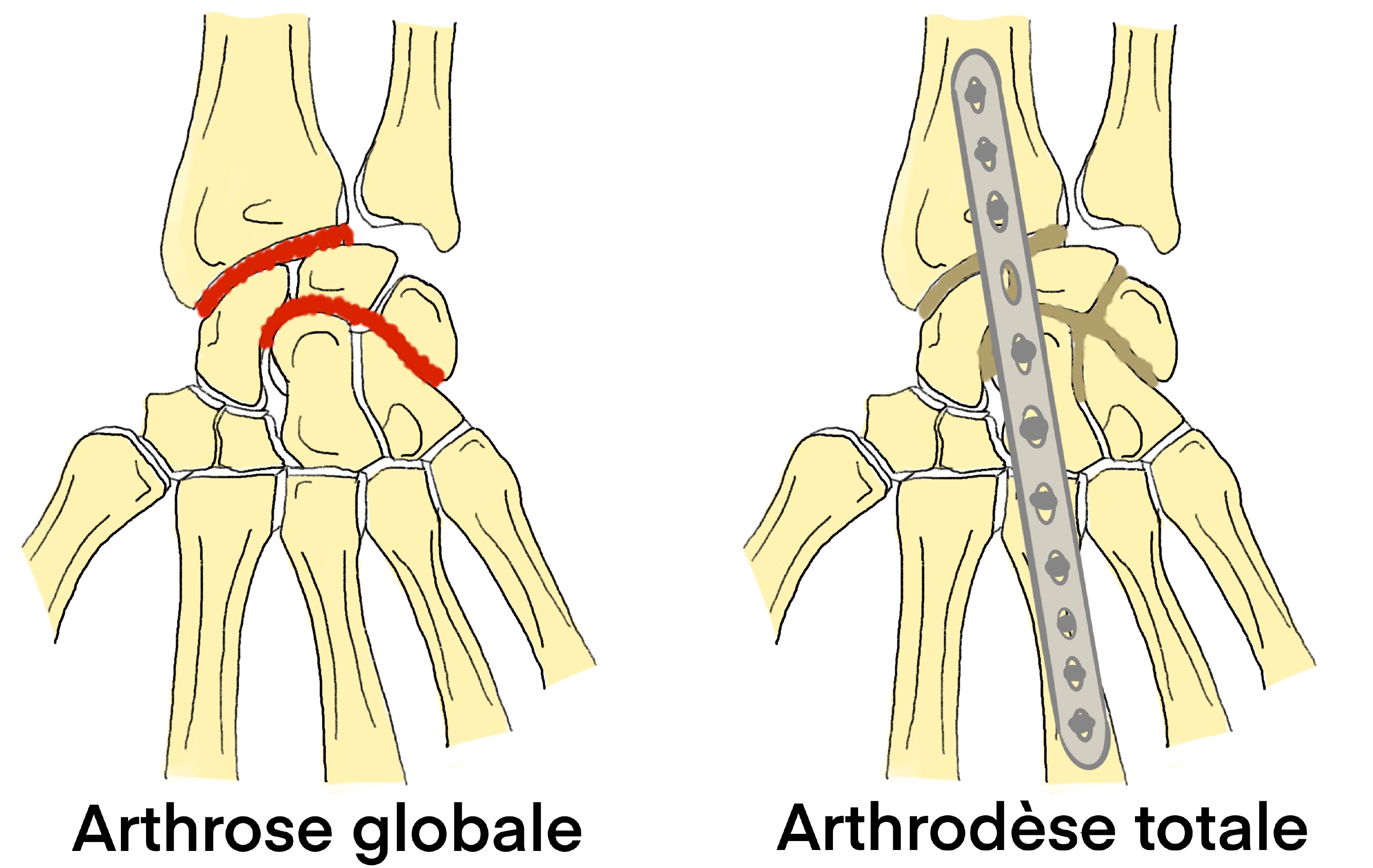Arthrodèse totale du poignet