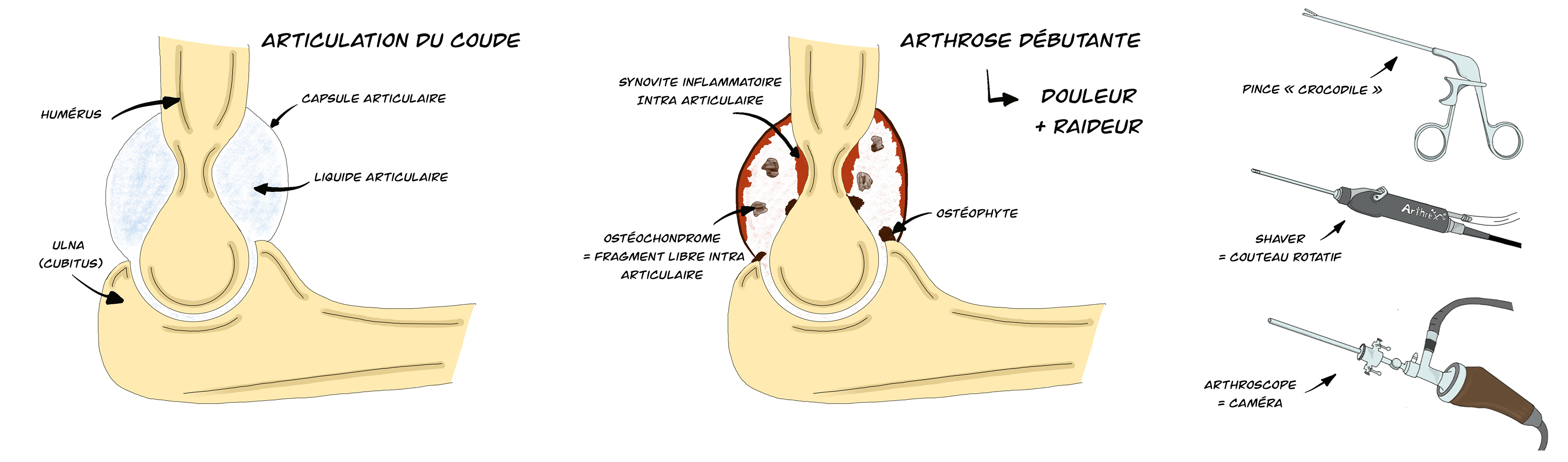 Arthrolyse arthroscopique de coude