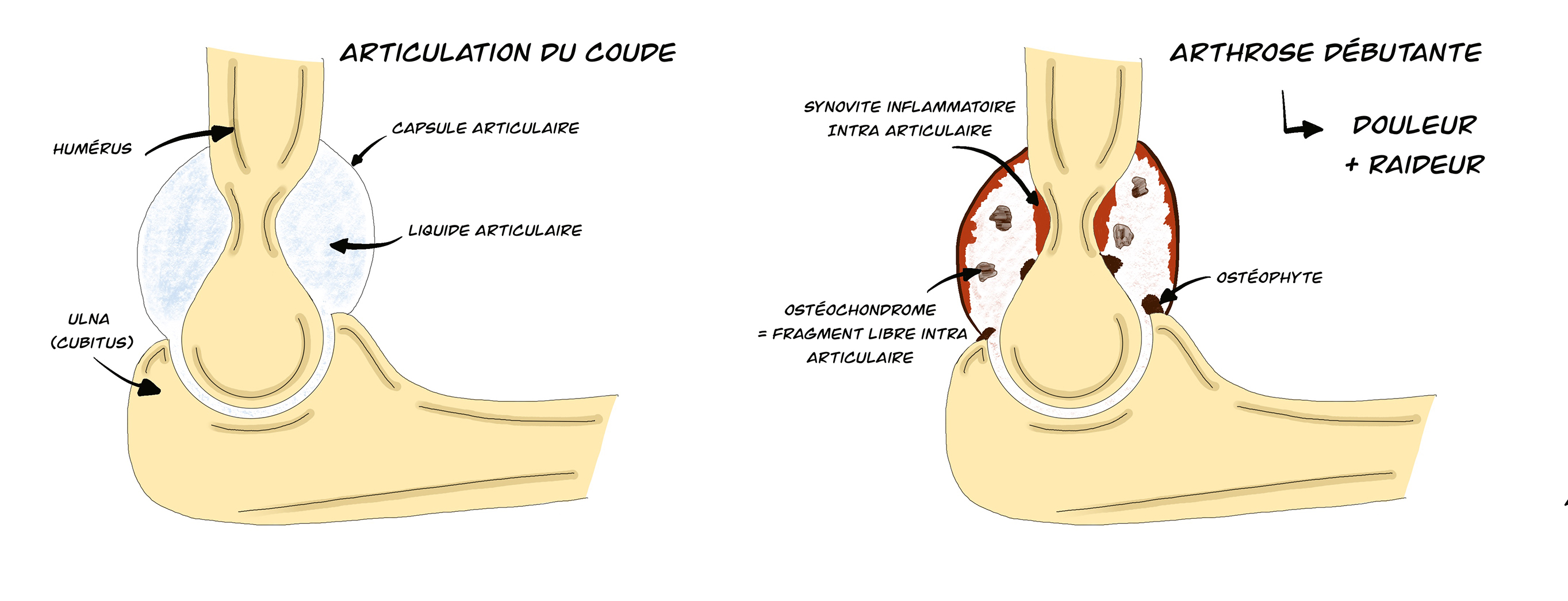 Arthrolyse du coude à ciel ouvert