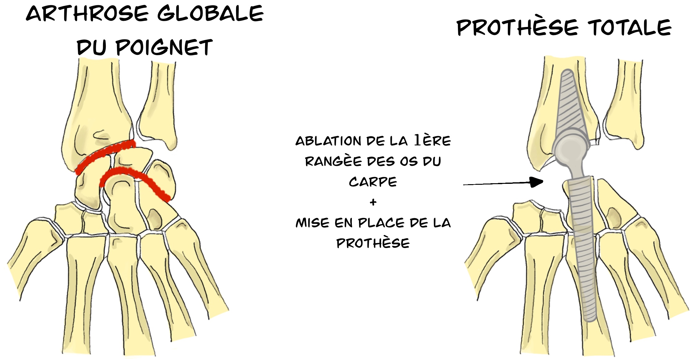 Arthroplastie totale du poignet