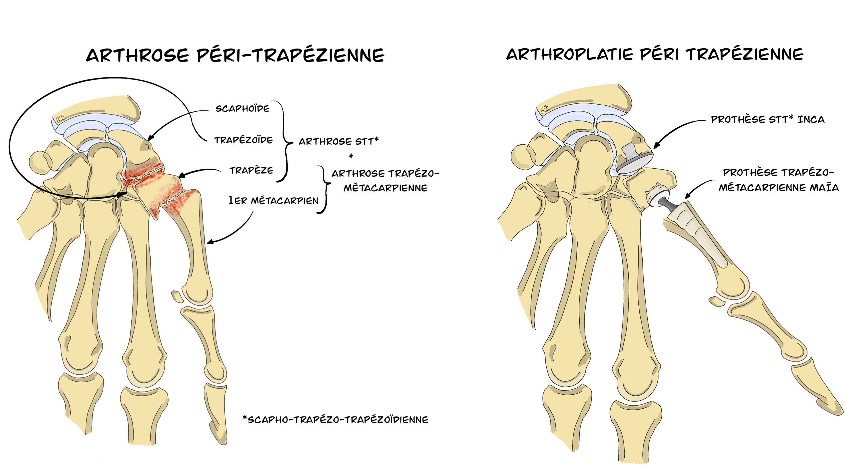 Arthrose Péri-trapézienne Burger