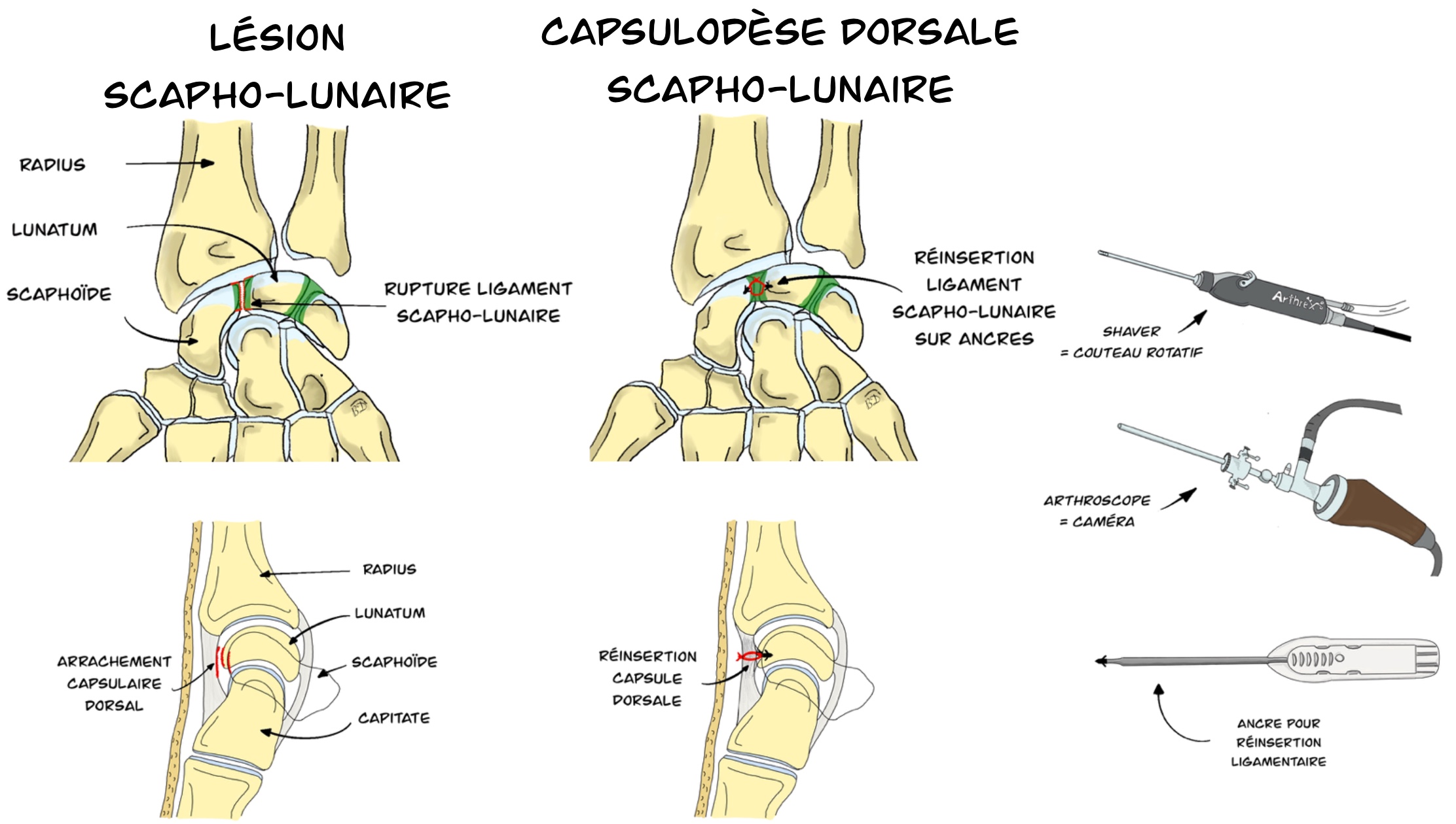 Capsulodèse dorsale Scapho-lunaire sous arthroscopie