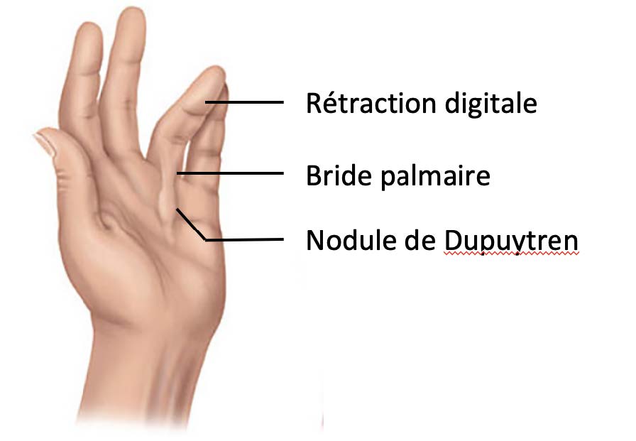 Fasciectomie pour maladie de dupuytren