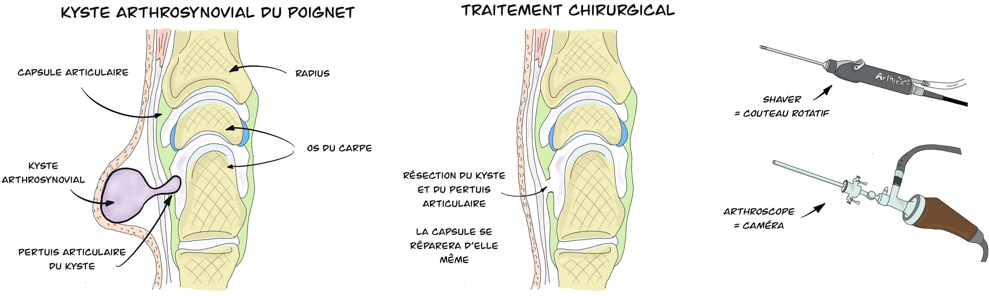 Kyste arthrosynovial du poignet sous arthroscopie