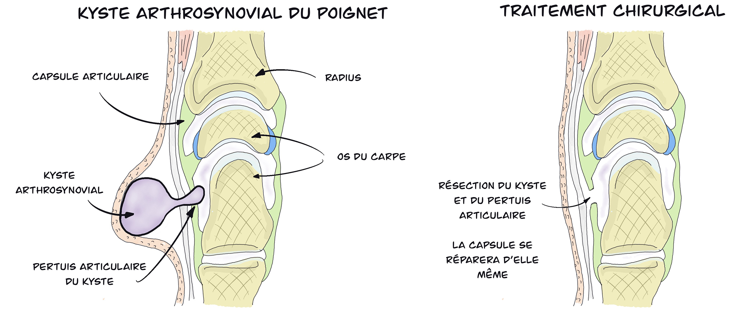 Kyste arthrosynovial (KAS) poignet ciel ouvert