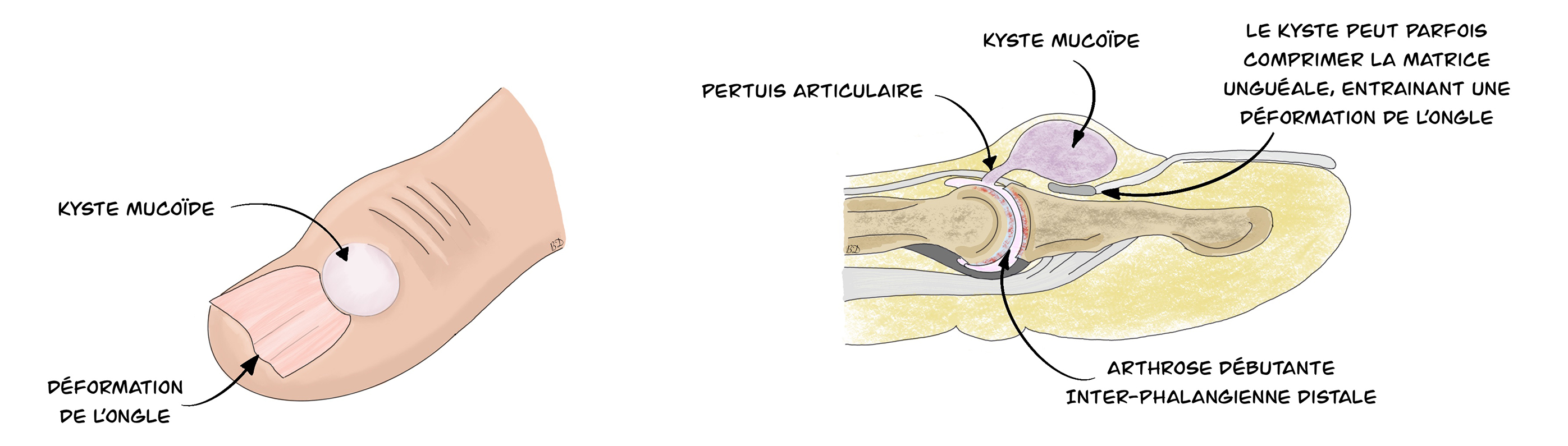 Kyste mucoïde