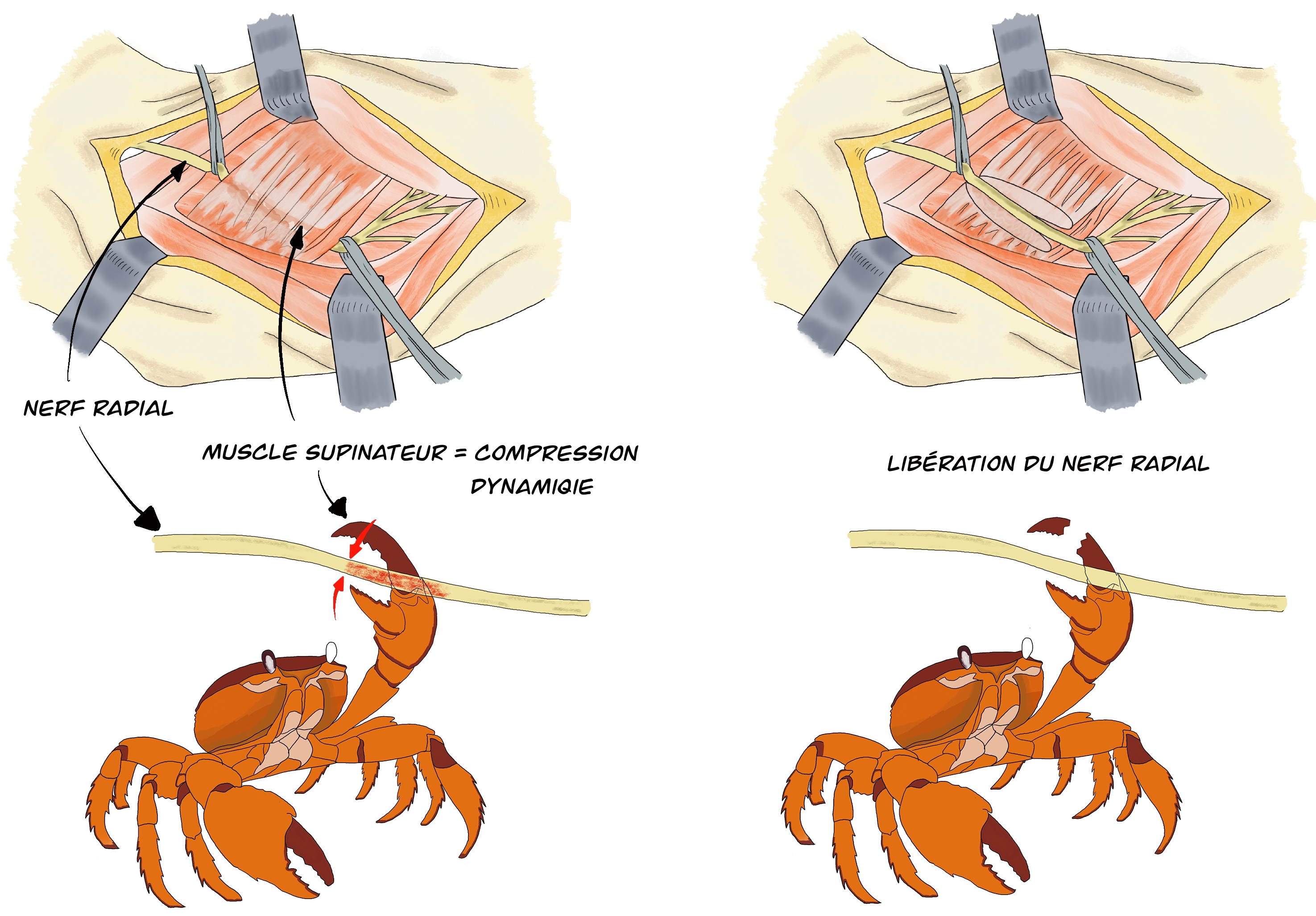 La libération du nerf radial au coude