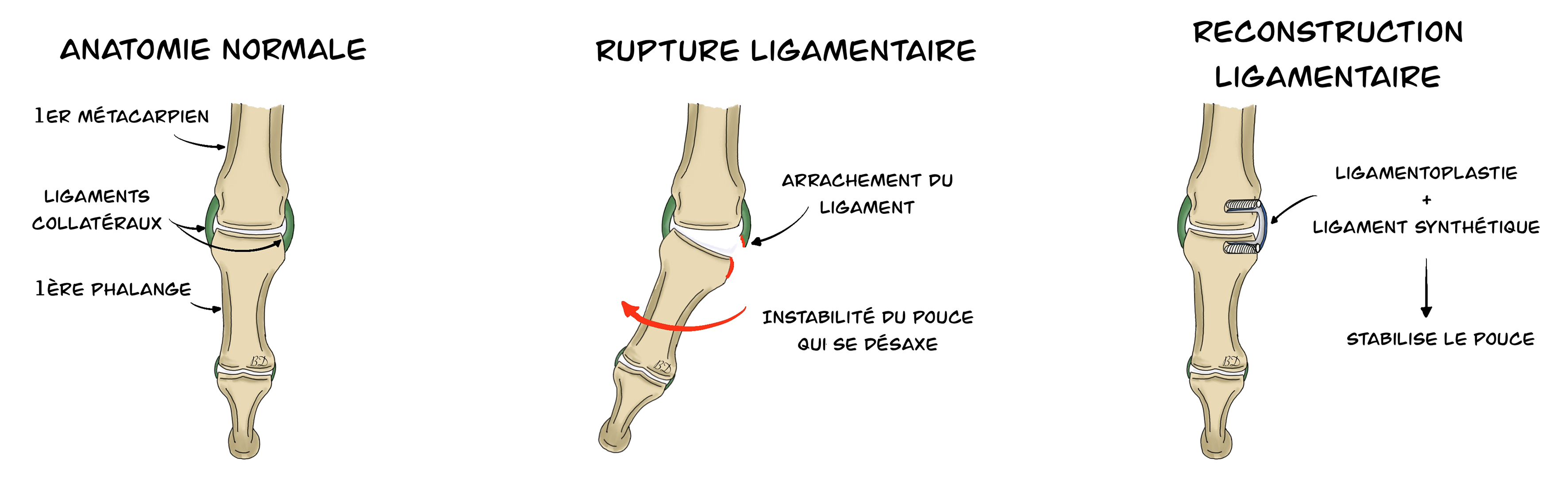 Ligamentoplastie métacarpo-phalangienne pouce