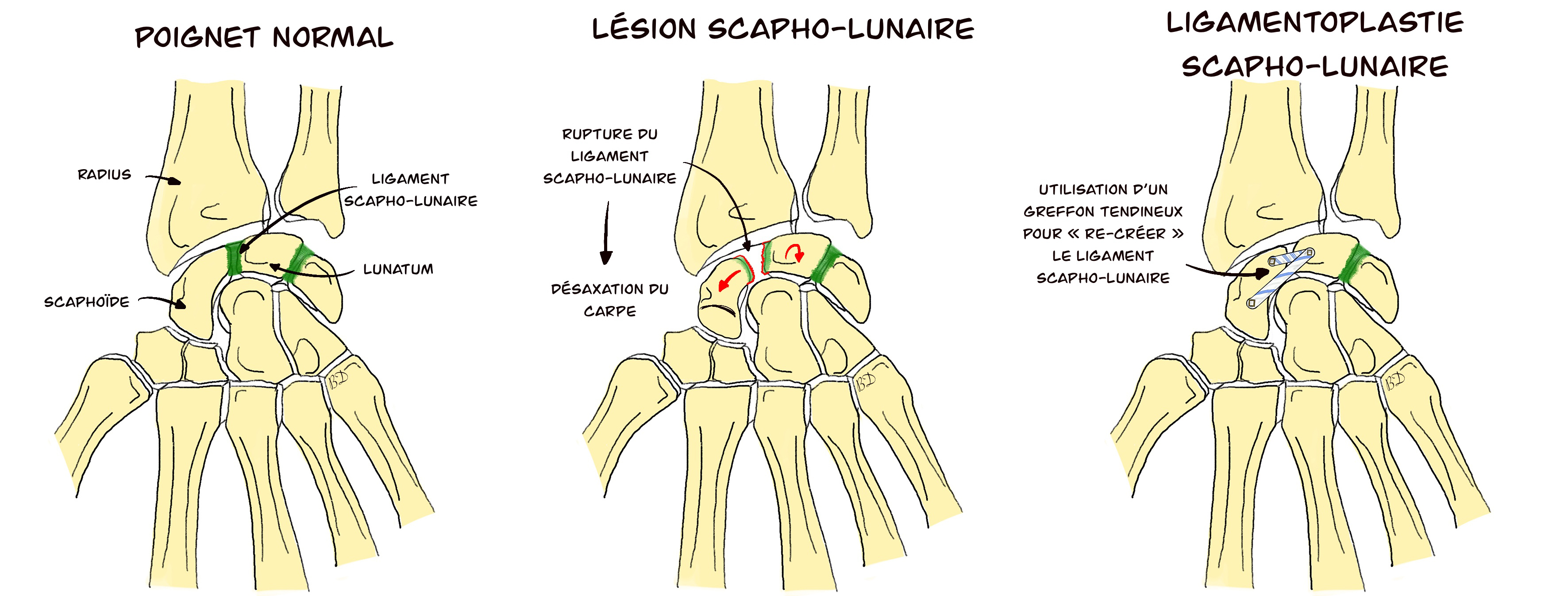 Ligamentoplastie scapho-lunaire du poignet