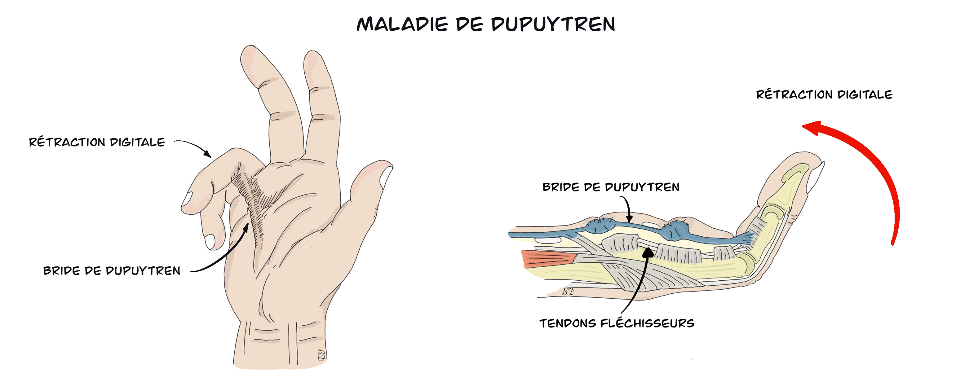 Maladie de dupuytren