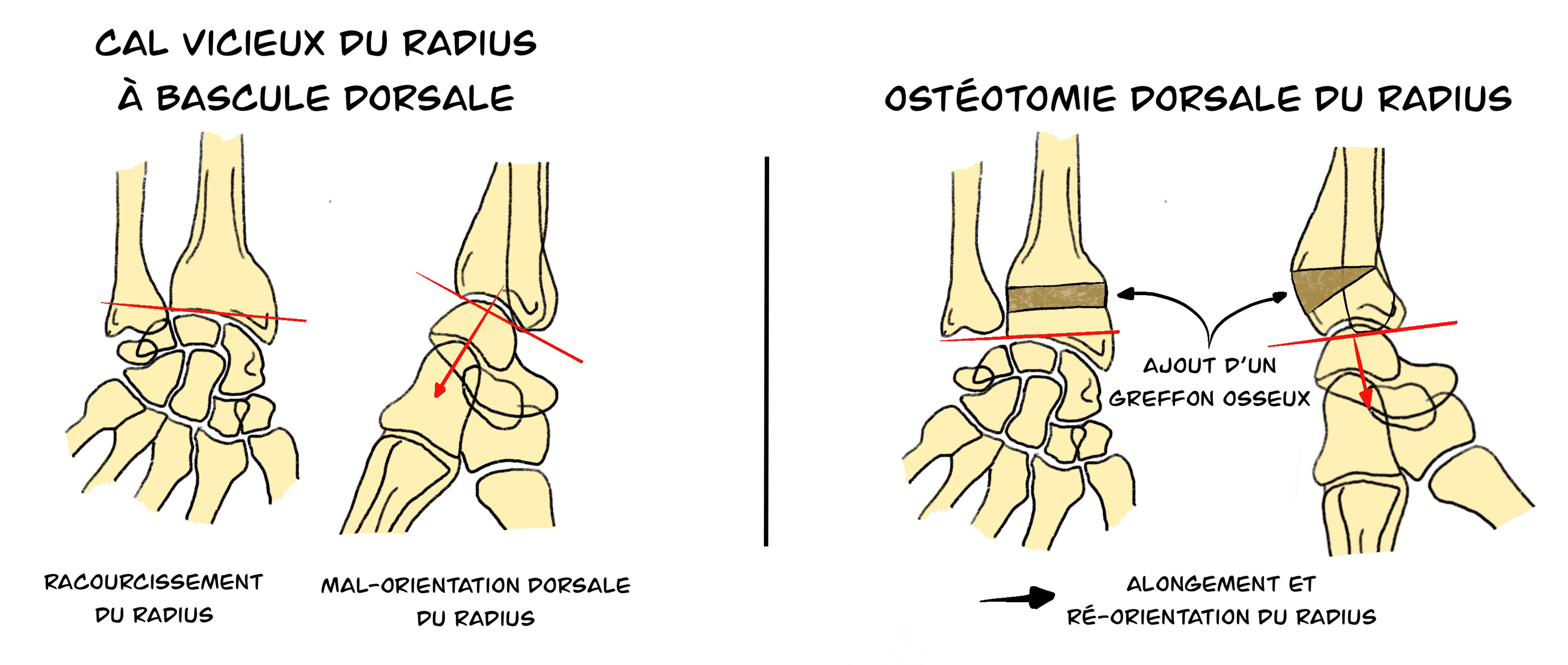 Ostéotomie dorsale du radius distal