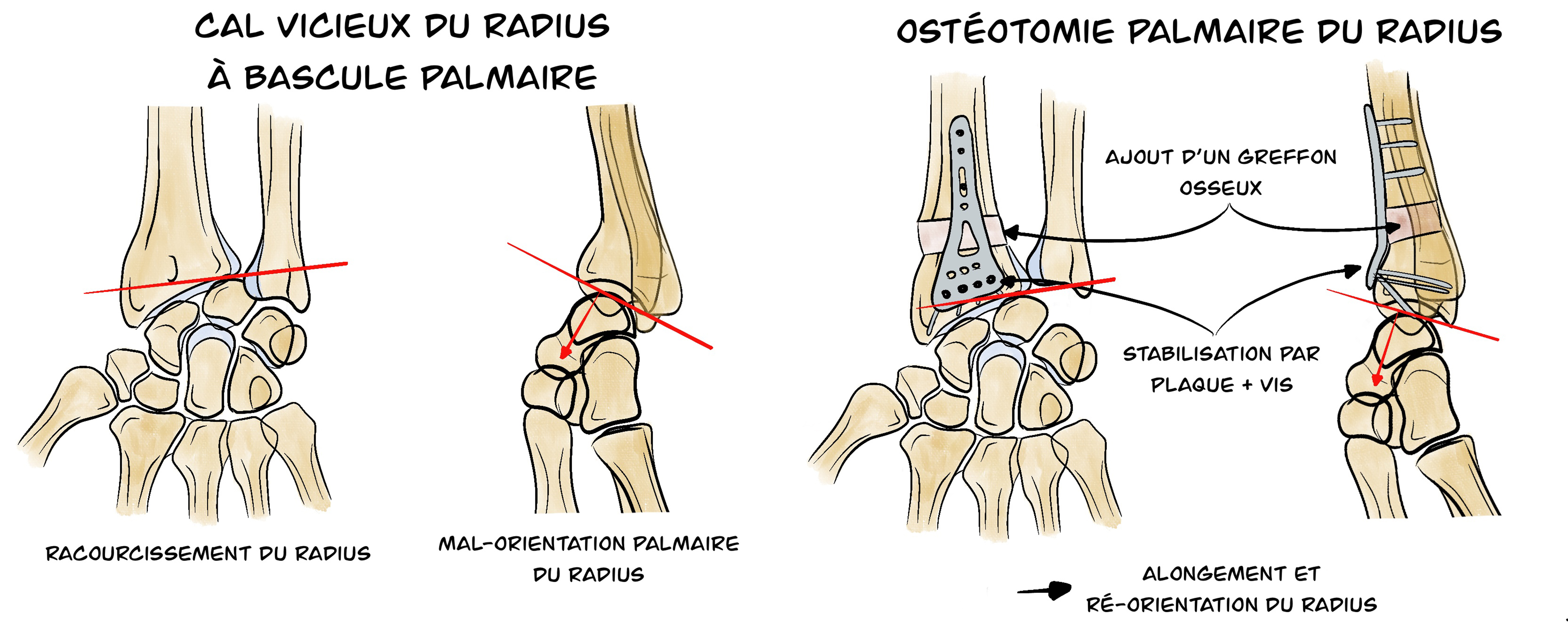 Ostéotomie palmaire du radius distal
