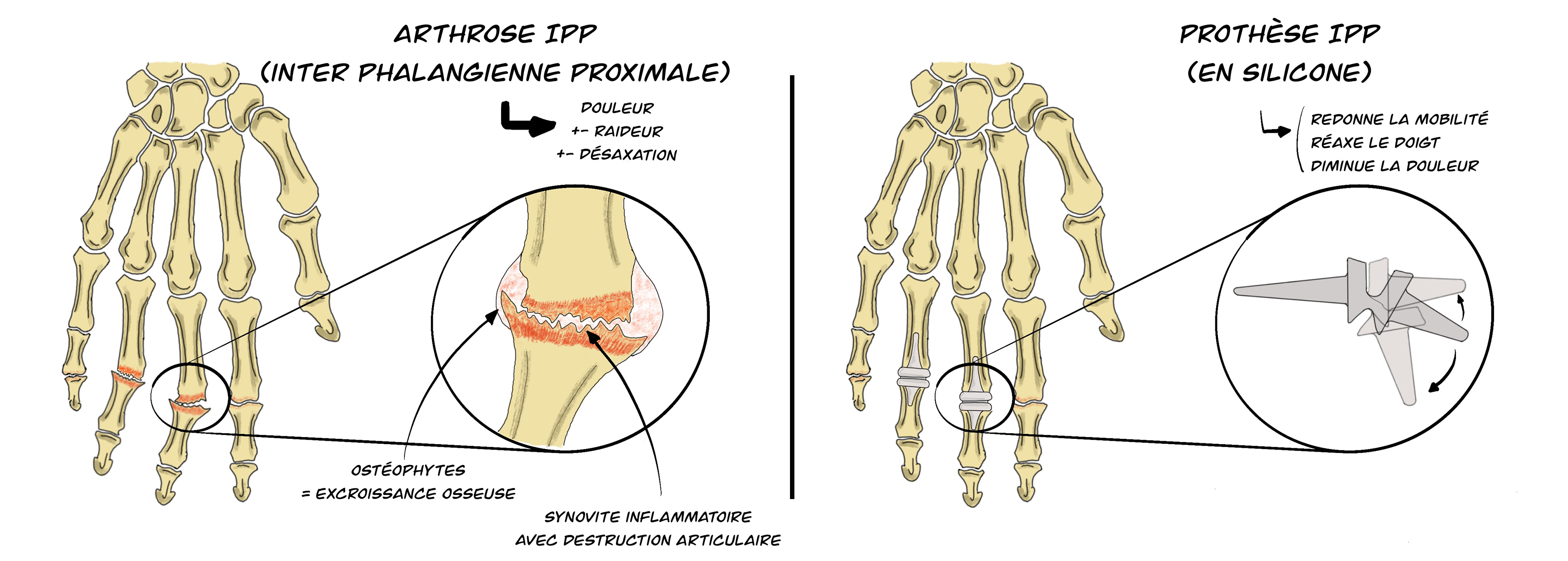 Prothèse inter-phalangienne proximale (IPP)