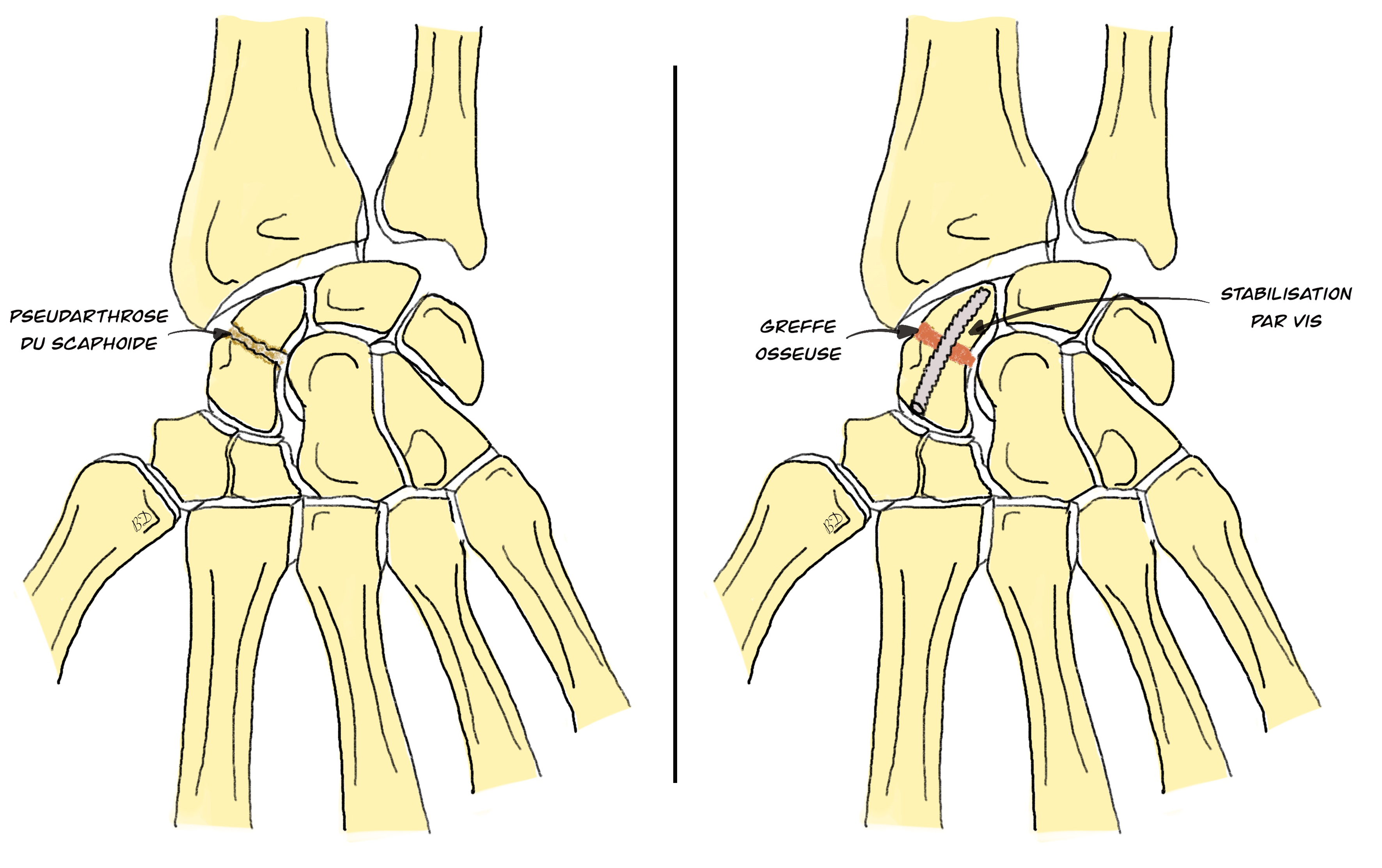 Pseudoarthrose du scaphoïde sous endoscopie