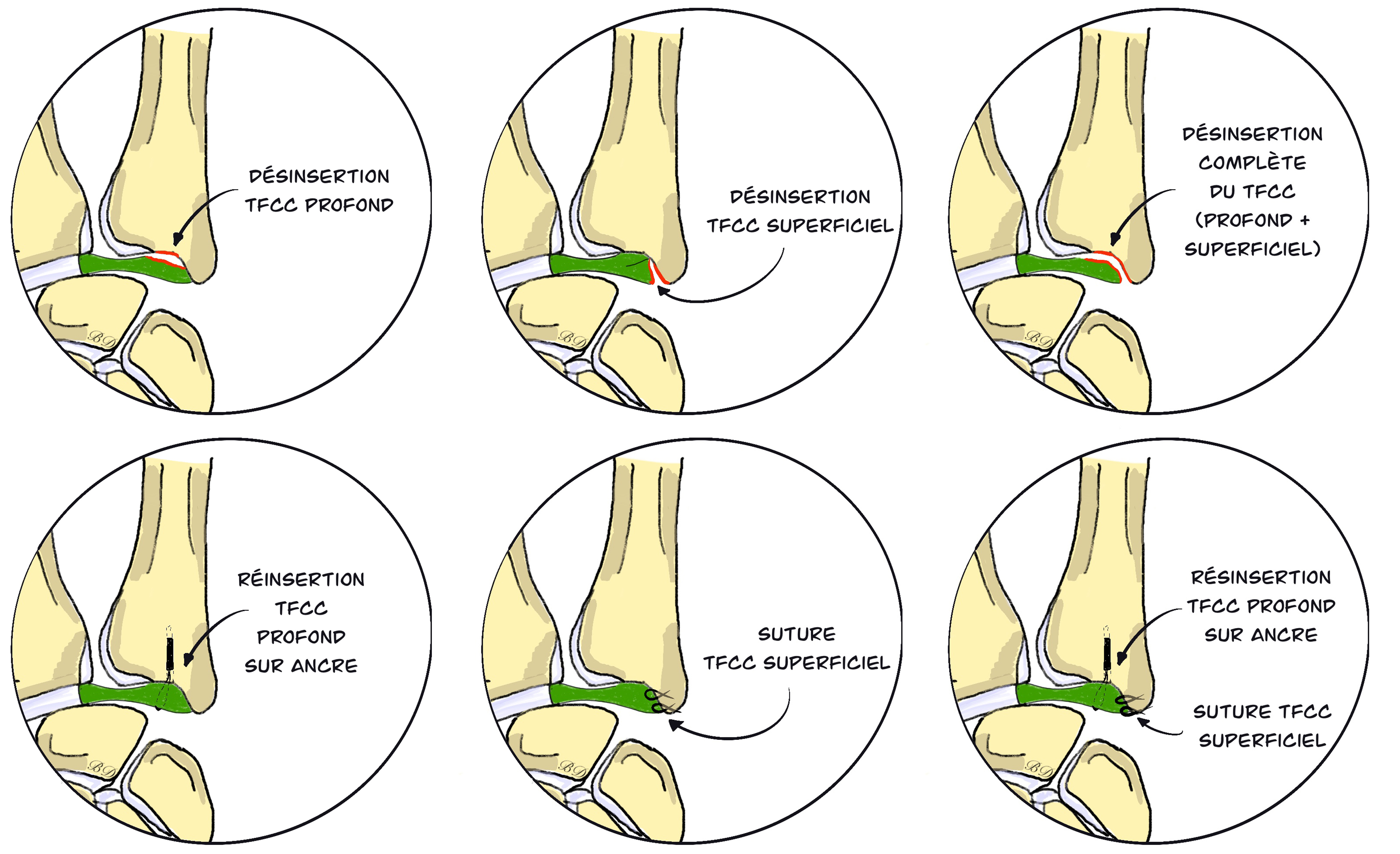 Étapes réinsertion du TFCC sous arthroscopie au poignet