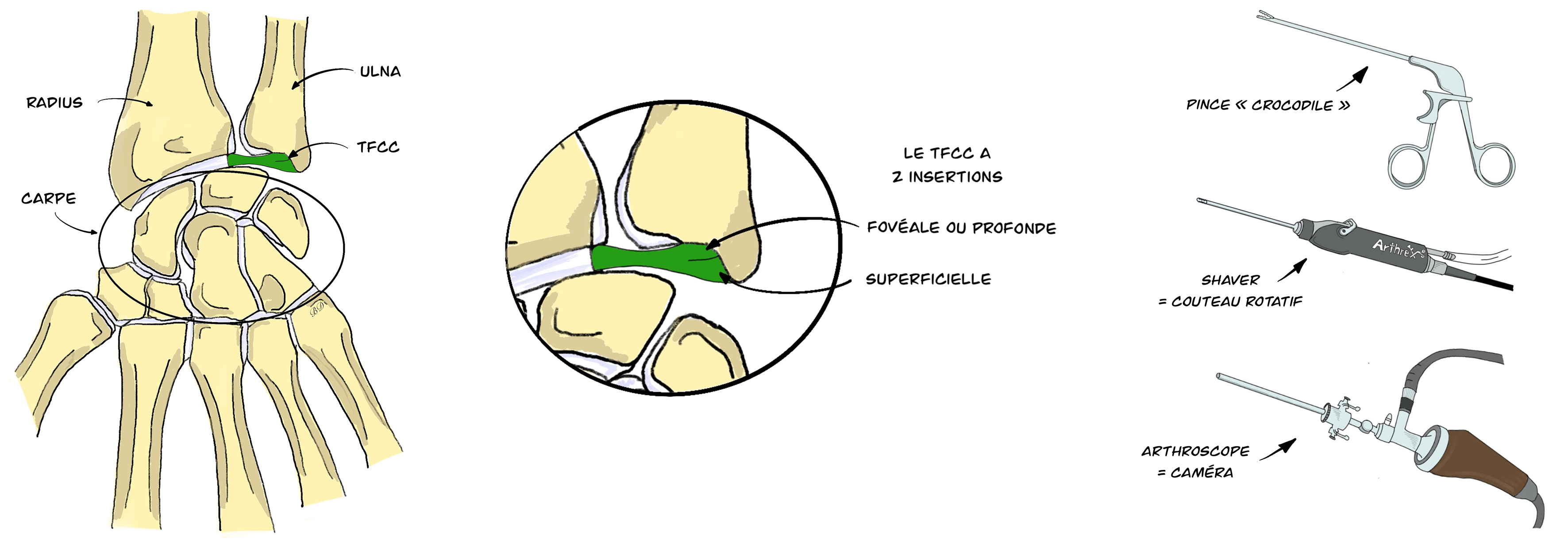 Réinsertion du TFCC sous arthroscopie au poignet