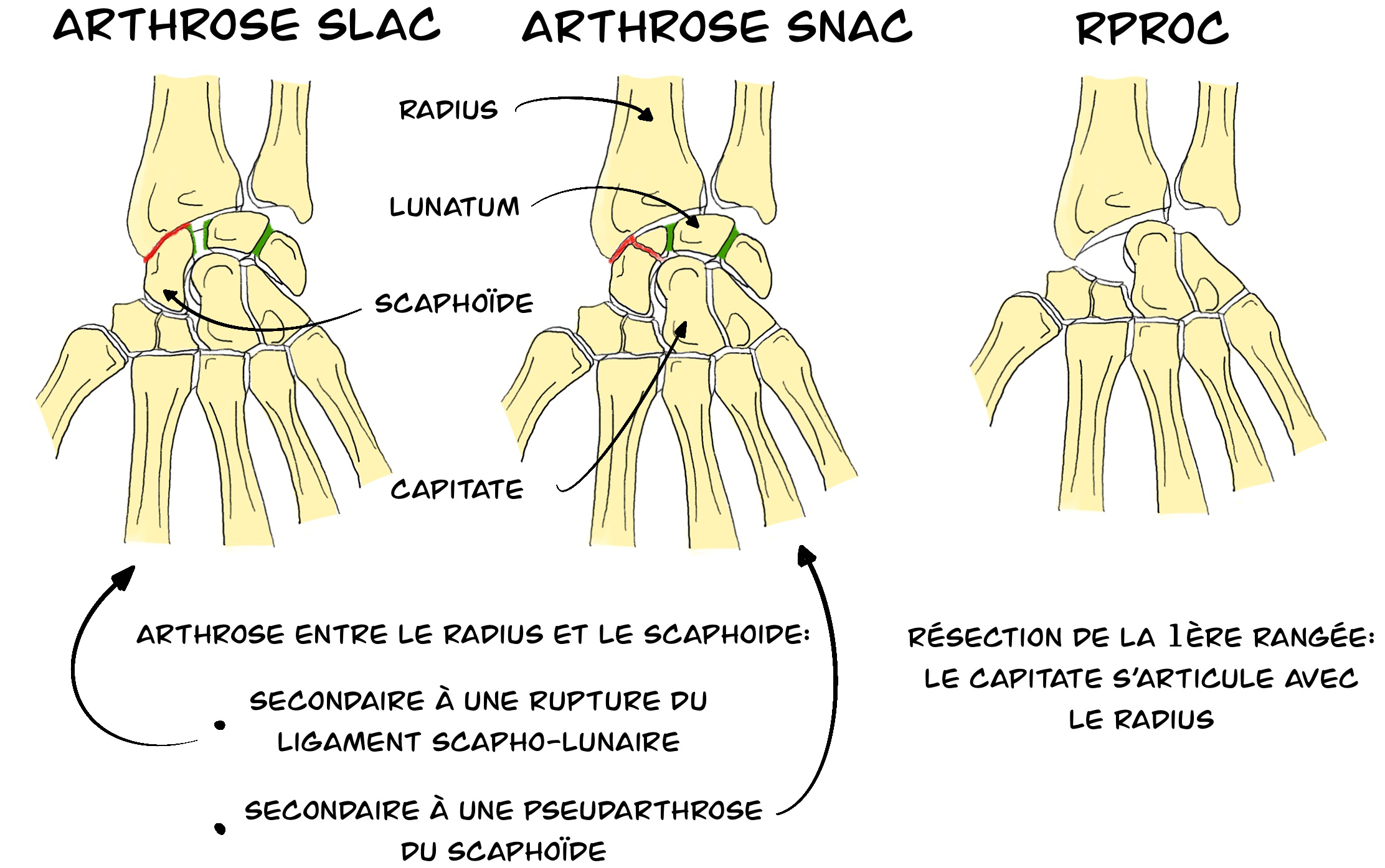 Résection de la première rangée des os du carpe au poignet
