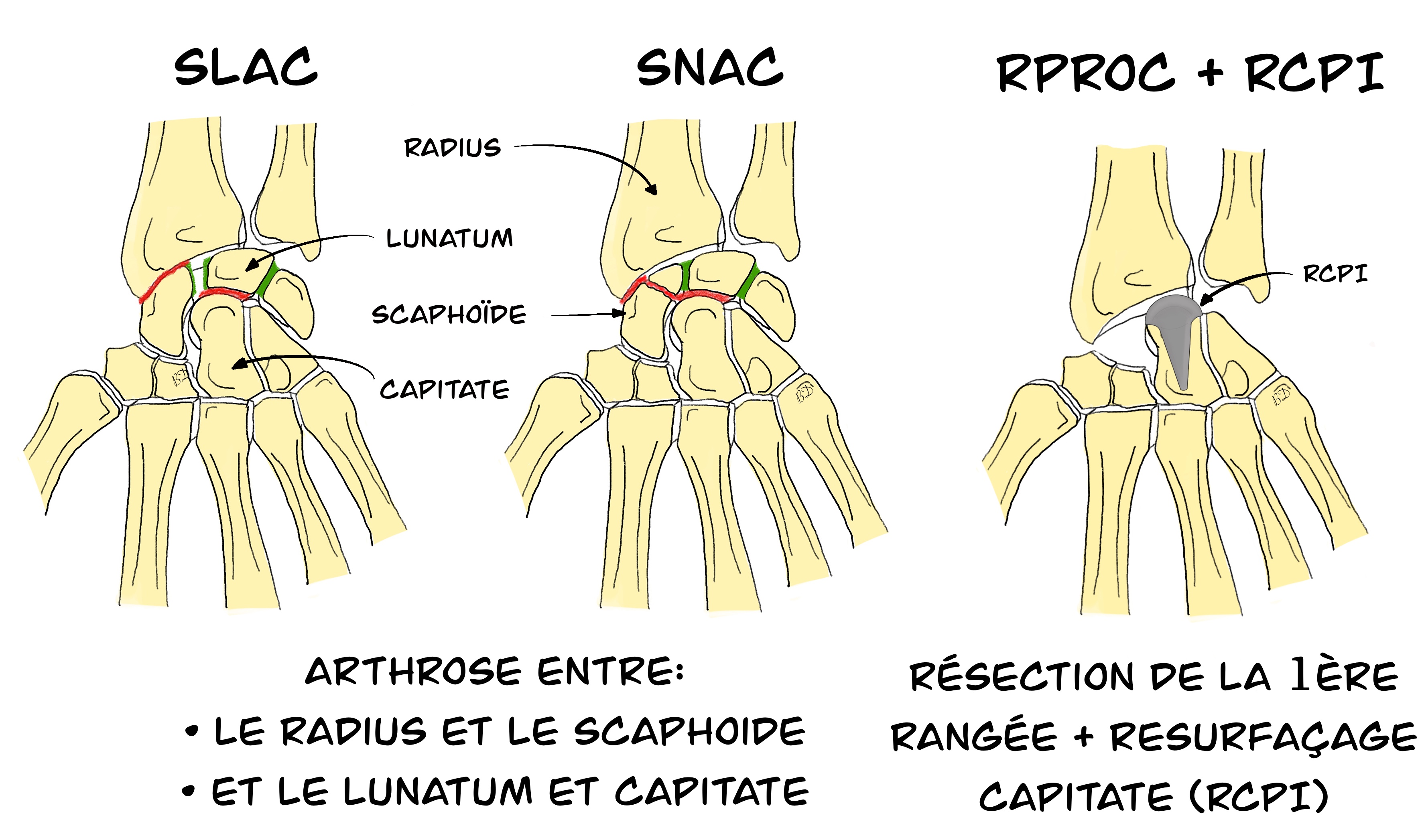 Résection de la première rangée des os du carpe au poignet