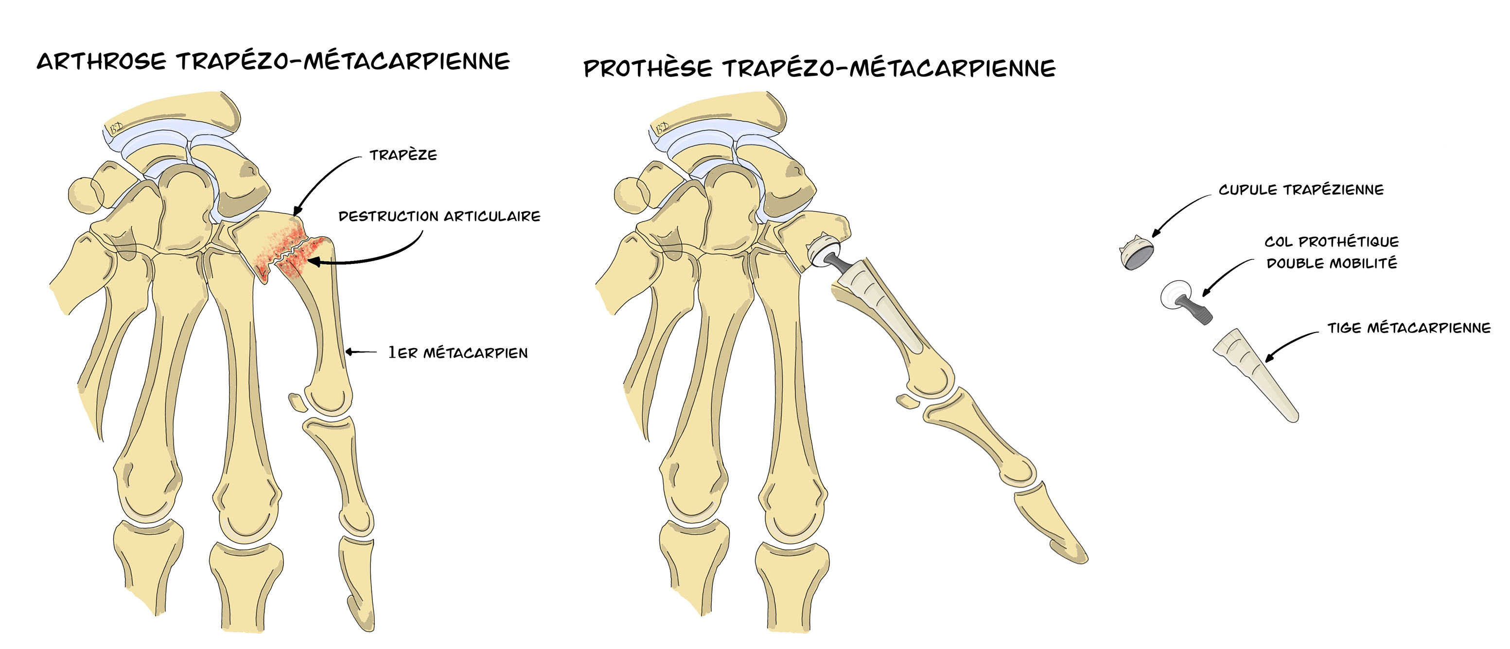 Rhizarthrose PTM-MAIA - Arthroplastie Trapézo-Métacarpienne