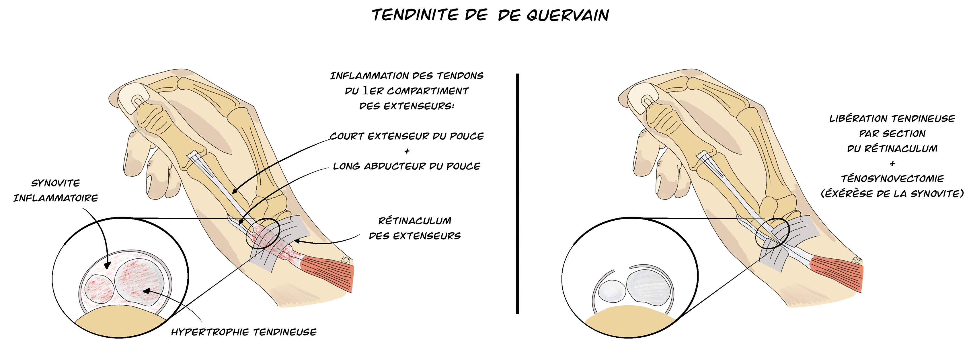 Tendinite de De Quervain